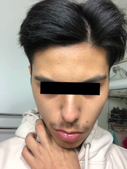 What is wrong with my face? One side flatter than the other. (Photos)