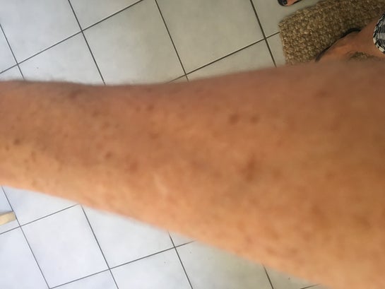 Removal Of Age Spots Sun Spots On Hands Arms And Legs Photo