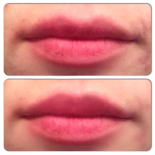 Could lip injections correct my wide Cupid's bow? (Photo)