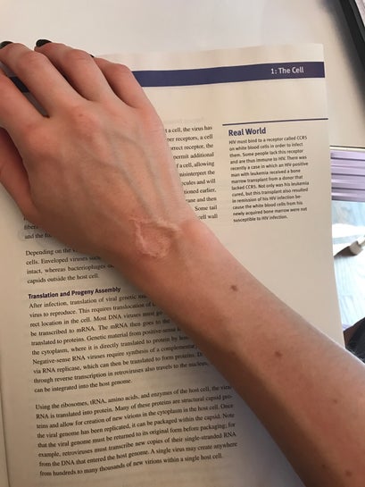 Sudden Bulging Arm And Hand Veins Sclerotherapy Photo