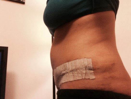 8 days post op Tummy Tuck, the swelling and tightness increasing instead of  decreasing. Is this normal? (photo)