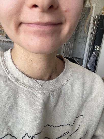 Will this smile line from overfilled lips ever go away now Will this smile line from overfilled lips ever go away now