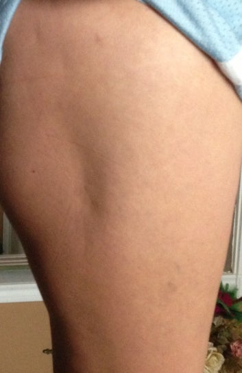 It is possible to build muscle on my outer thigh to diminish the dent without having fat grafting? (Photo) It is possible to build muscle on my outer thigh to diminish the dent without having fat grafting? (Photo)