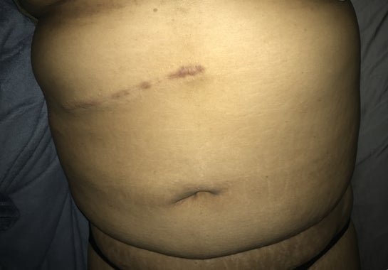 healed gallbladder removal scars