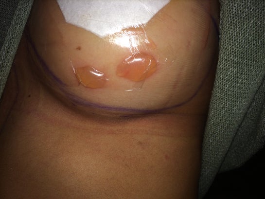I just had Breast Augmentation and noticed these blisters. Is this normal  and what it is? (photo)