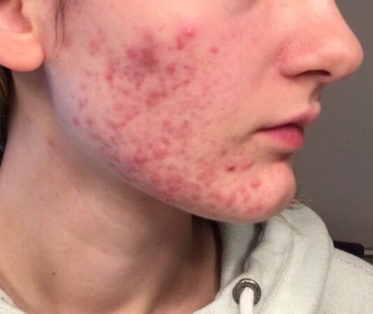 pie acne scars treatment