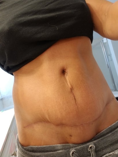 3 months post op of Tummy Tuck, the scar is very red. Is this normal?  (photos)