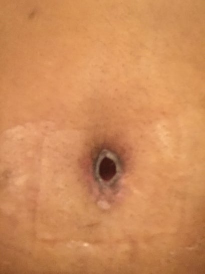 Open belly button hole following Tummy tuck is this normal photos