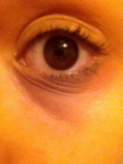 fine lines under eyes at 23