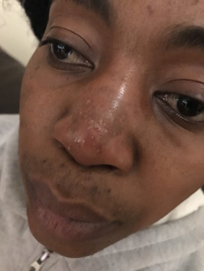 Nose Job With Filler Gone Wrong Swelling And Redness All Over My Nose How Long Will The Swelling Stay Photo In our practice, we do not recommend fillers placed in the nose for a long variety of reasons, and especially not in the tip of the nose. nose job with filler gone wrong