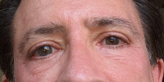 What can I do to correct wrinkles in the under eyes after I heal from a