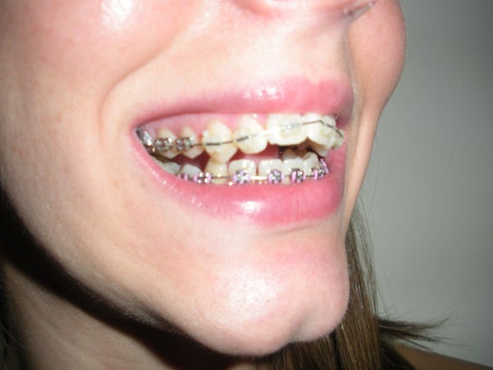 Is It Normal For Spaces To Be Created By Braces