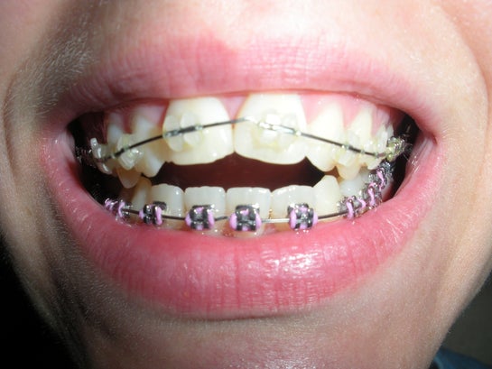 Is It Normal For Spaces To Be Created By Braces