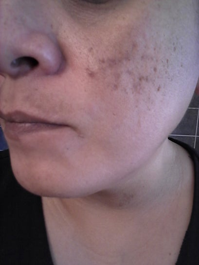 skin craters on face