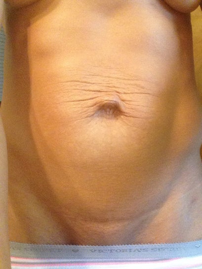 Short Scar Tummy Tuck 