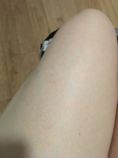 I have very visible green veins on my legs. Can these be treated? (photos)