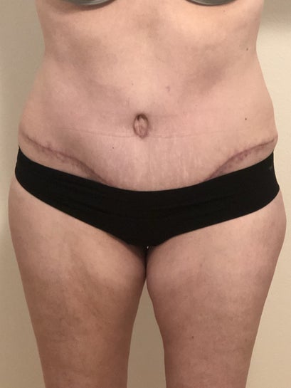 Does this look like a muscle repair failure or another issues? 49, 5'6, 125  lbs 4 months post (photo)
