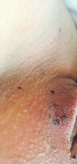 Black Spots Around Vagina