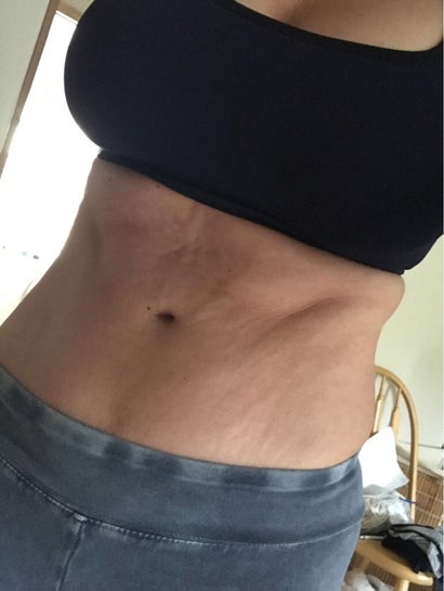 Why does my ab skin look bad after tummy tuck? It's been 11 months