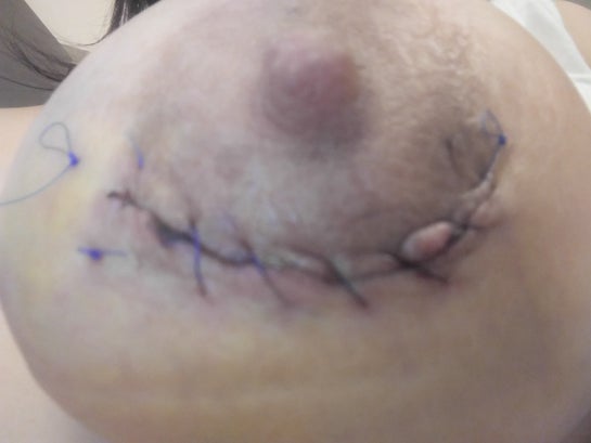 Why are my areolas different from each other in shape and raised up off my  skin where the incisions were made? (Photos)