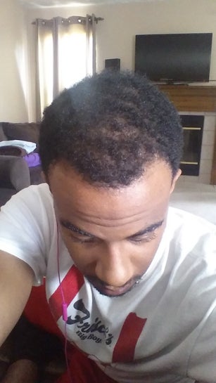 25 Black Male Embarrassed My Hair Is Thinning And Hairline Receding What Are My Options Photo