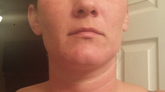 Fat transfer to lips. (photo)
