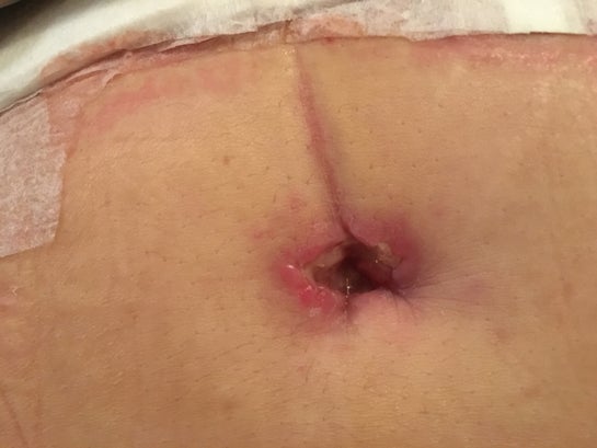Infected belly button and infected tummy tuck incision. Infected belly button and infected tummy tuck incision.