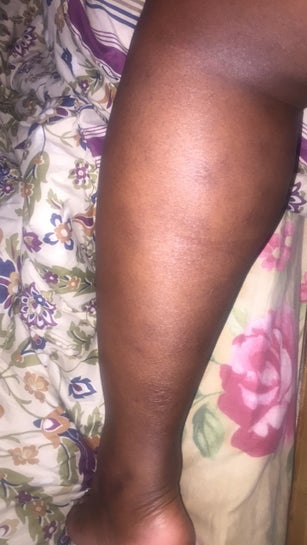 How to get rid of Dark spots, Scar, Mosquito Bites, Hyperpigmentation on  legs fast. 