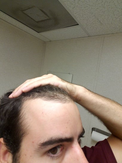 Hairline age receding 3 Ways