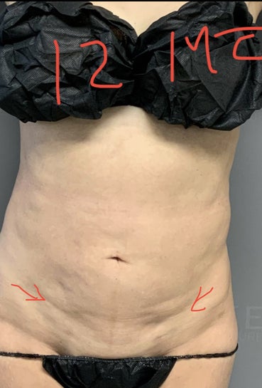 How to Prevent and Correct Uneven Areas in Your Belly After Liposuction