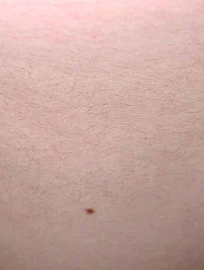 Laser hair removal for fine dark hair Photo