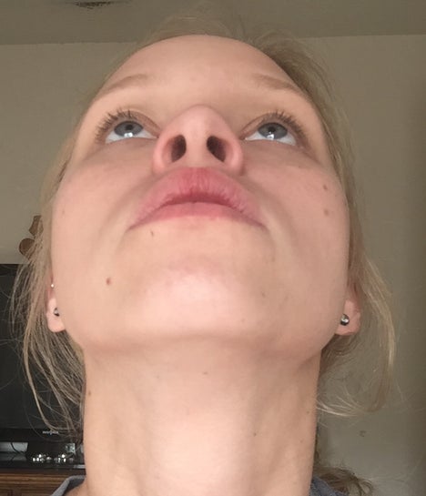 The Right Cartilage Of My Nose Seems To Have Either Caved In Or Flipped What Are My Options With Out Ruining It Worse Photo