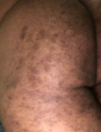 hyperpigmentation on buttocks cream