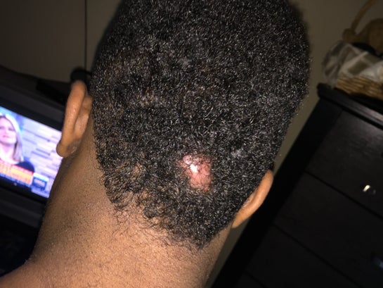 I Have A Keloid On The Back Of My Head I Ve Been Getting The Steroid Shot For A Year And I Just Want To Have Surgery Photo