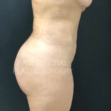 Professional sales plastic surgery