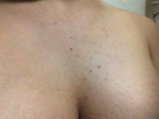 What Is Under Boob Acne? (Causes, Treatments, and More)