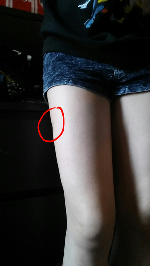 What can I do to fix the dent in my right thigh? (Photo) What can I do to fix the dent in my right thigh? (Photo)
