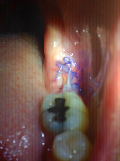 Should Bone Graft Be Re Stitched Can It Continue To Heal If The Incision Is Slightly Open Antibiotics Are Finished Photo