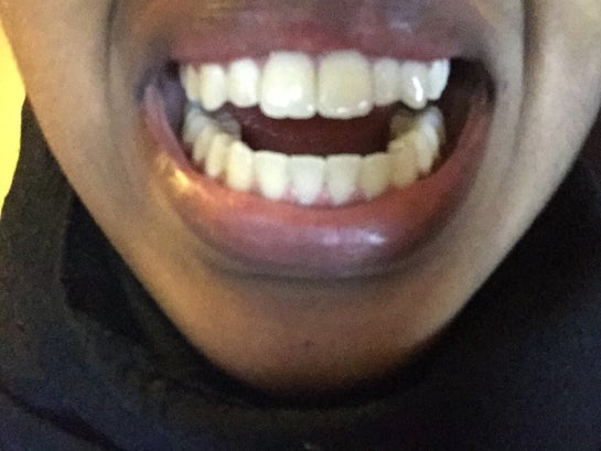 Can I Get My Front Teeth Filed So They Aren T As Long I Recently Got My Braces Removed And My Teeth Are Now Straight Photo