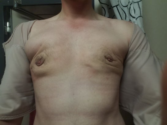 Skin Folds Lumps And Uneven Result 7 Weeks Post Gynecomastia Surgery Opinion Photos