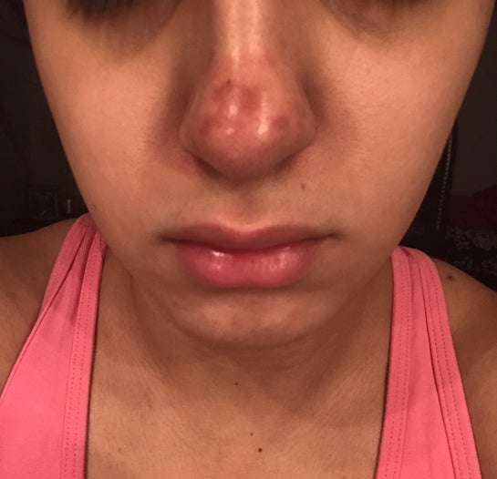 nose skin peeling