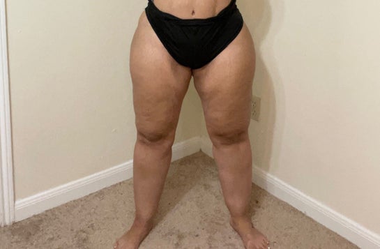 Lipedema  Lipedema Surgery