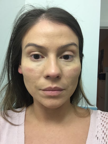 Swelling under shop eye on cheekbone