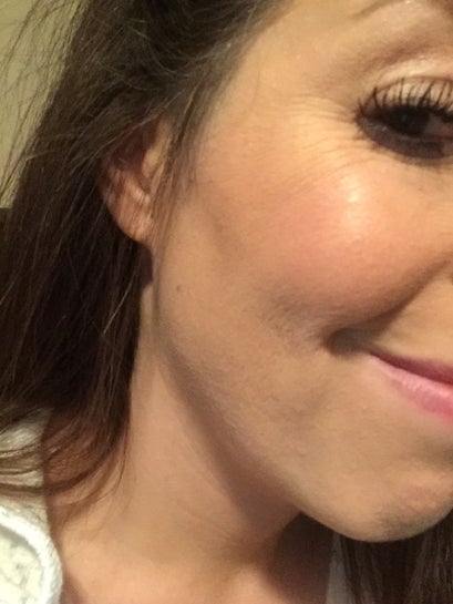 vertical wrinkles under eyes