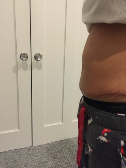 Stomach Lump Above Belly Button 