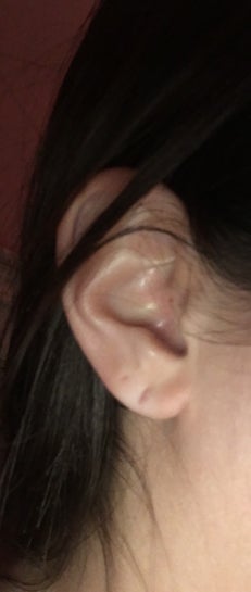 My Nine-year-old's Ear Piercing Ripped, Not All the Way Through, but Close?