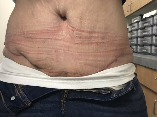 Tummy tuck gone wrong? 2 months post op. (photos)