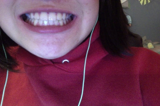 Did my orthodontist mess up? My two front teeth are protruding out