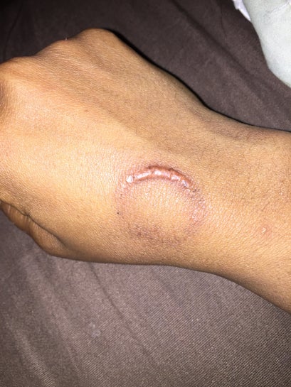 human bite marks on skin