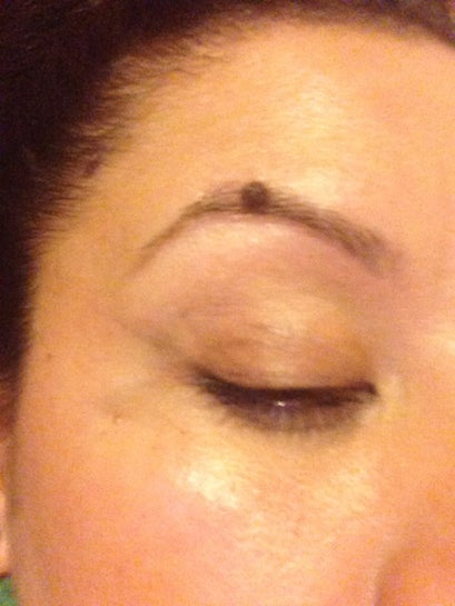 Will I Still Have Hair on my Eyebrow if I Remove a Mole I Have Right on my Eyebrow? (photo)